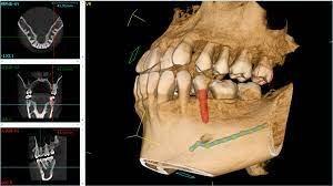 Sample CT Scan - Implant simulation with mandibular canal for accurate implant placement.