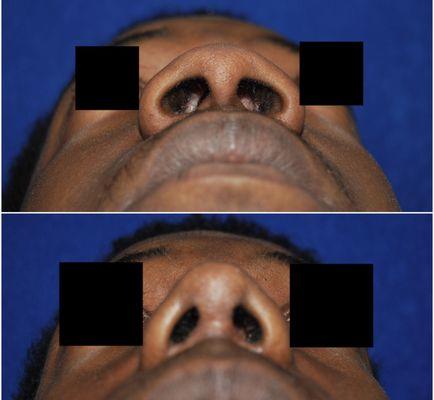 Ethnic Rhinoplasty (bottom view)