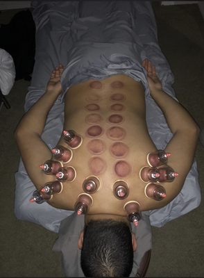 Cupping session