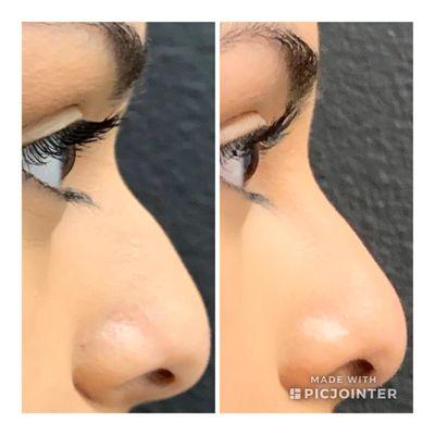 Non Surgical Rhinoplasty