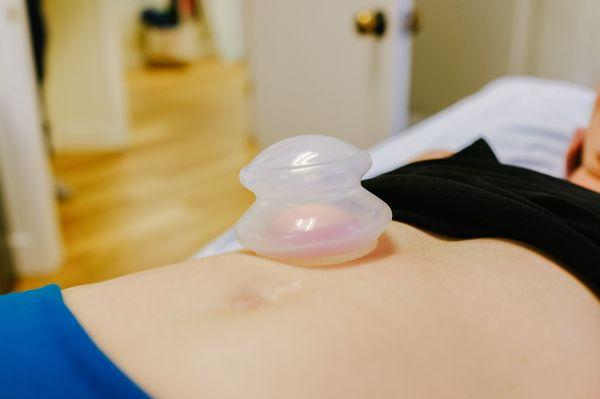 Cupping - a manual therapy technique to address fascial restrictions