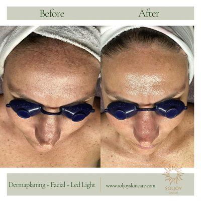 Dermaplaning Treatment with Led Light.