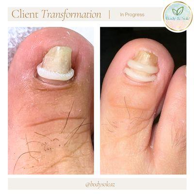 Onyfix is a class 2 medical device designed to painlessly and permanently eliminate I grown and involuted toenails!