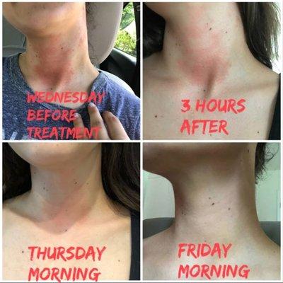 Before and after pictures of treatment for an allergic reaction.