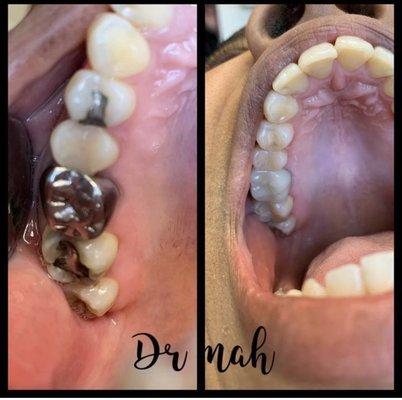 zirconia crown and inlays can replace silver fillings