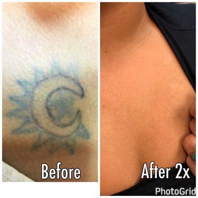 Picosure tattoo removal