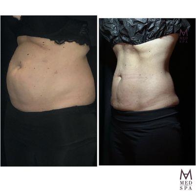 Coolsculpting before & after