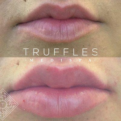 juvederm lip filler before and after photo