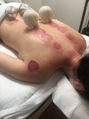 CUPPING