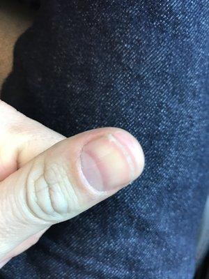 Another raw fingertip