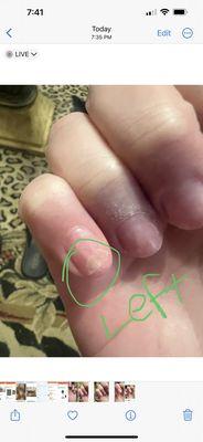 Fungus on both pinky nails and right middle finger