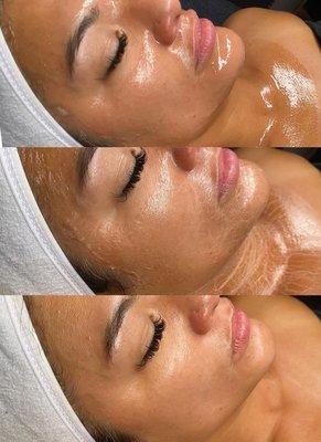 Natural "Botox" facial, firming peptide mask gives instant results of firm and tight skin without needles.