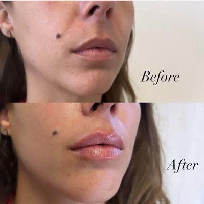 Lip and Smile Line filler