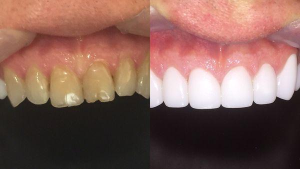 Before and After CEREC Crowns