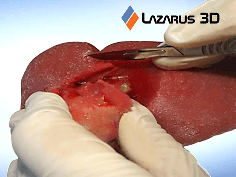 Partial Nephrectomy Model