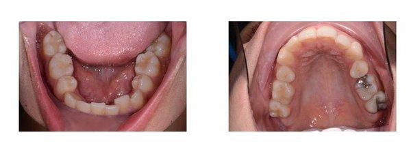 Invisalign: Before - November 2015