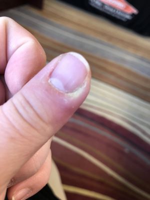 Infected finger