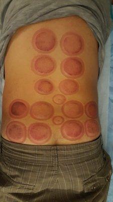 Cupping for muscle soreness and pain