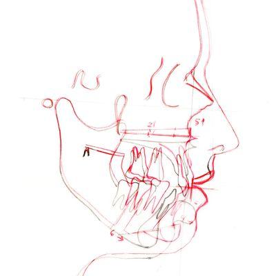 Jaw surgery