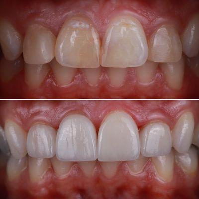 Porcelain veneers and zoom whitening