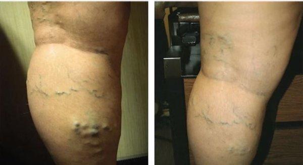 Varicose Veins