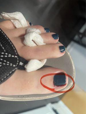 Cut/cuticle tear from pedicure