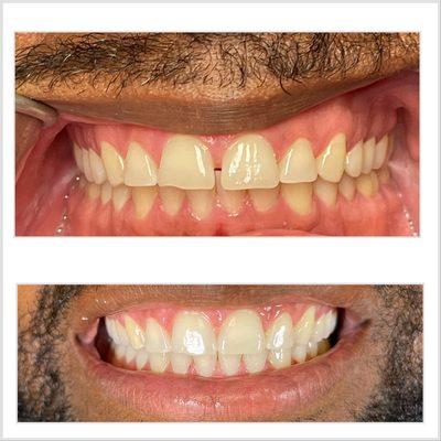 Anterior spacing closed using  Clear Aligners. Avoiding the need for veneers or crowns that would require shaving down healthy teeth!