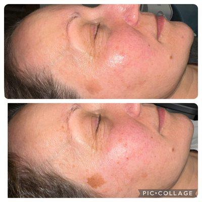 Ipl photofacial in Burnsville