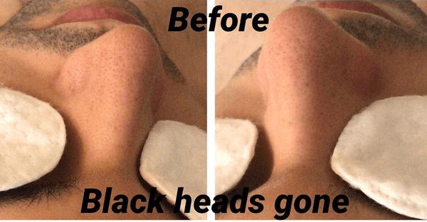 Blackhead removal - before