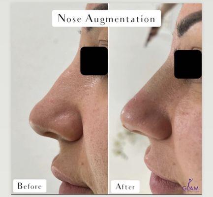 Nose Augmentation using PDO Threads & Filler