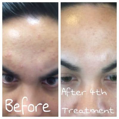 before treatment & after 4th botanical peel.