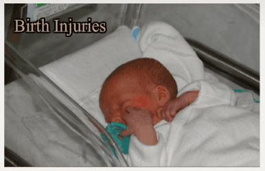 Birth Injuries