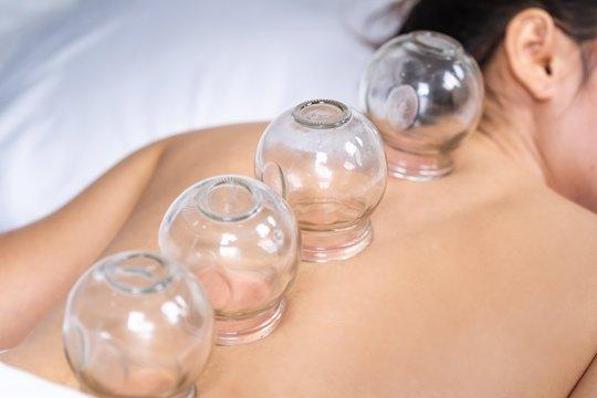 Cupping to help with pain, stress and other ailments.