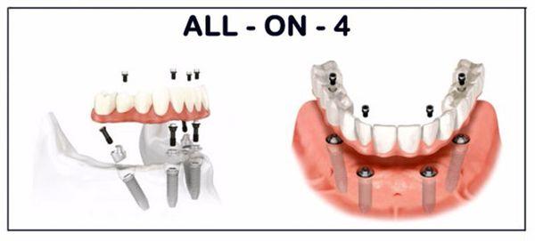 All on 4 Dental Implants New York