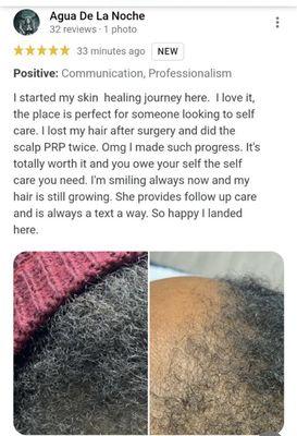 PRP Scalp results in just 3 months. Advanced Technology in Medical Aesthetics Specialty by Aesthetics PRP by LeAnna LME.