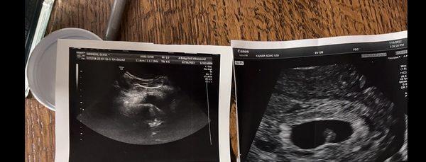 The left side is the baby visit ultrasound and the right side is my doctors ultrasound