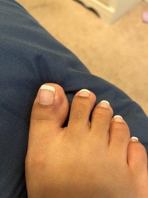 Swollen toe