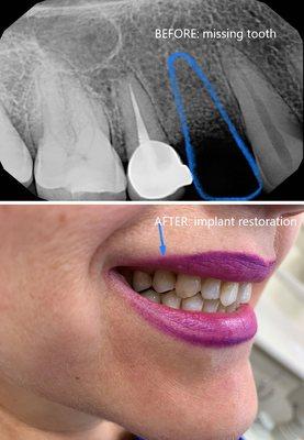 Implant Restoration