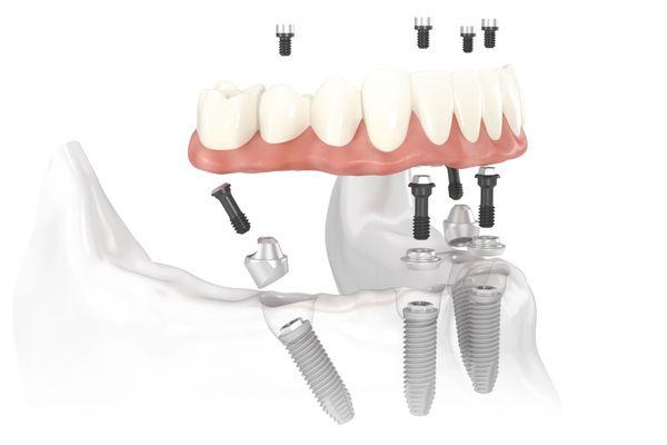 We Specialized in All-on-4 and Teeth In A Day