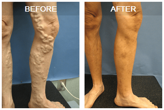 Varicose veins treated by Dr. Harper in Macon, GA