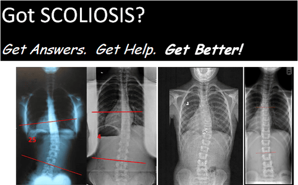 We have patients from around the world who come to our clinic for the most advanced scoliosis exercise based treatments....