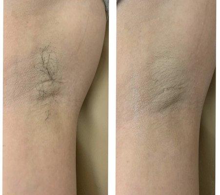 4 Week Underarm Wax