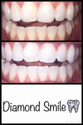 Diamond Smile Whitening