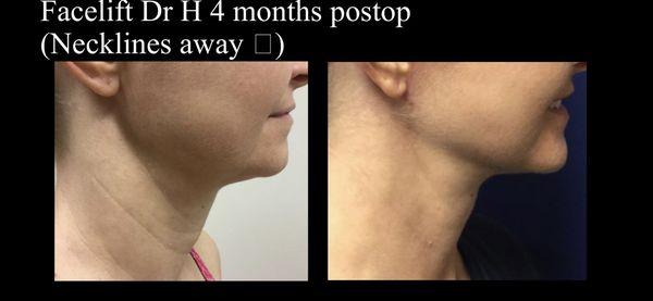 Neck lift defining the youthful jowl neck angle.