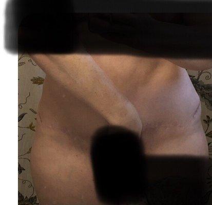 Extremely uneven scar, large uneven lump of extra skin on hip.