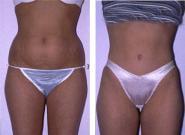 Before and After Abdominoplasty