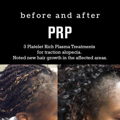 PRP (Platelet Rich Plasma) for traction alopecia