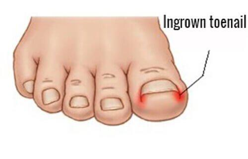 Ingrown toenails