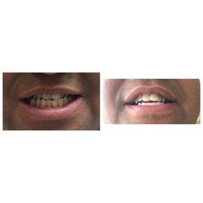 Amazing whitening! Before & after on my father for his Christmas gift! Amazing what they can do!