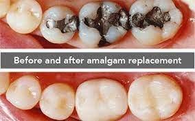 Amalgam metal removal with biocompatible white color composites